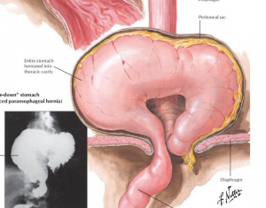Giourdas Xeirourgiki Βασίλειος Γκιούρδας Βαρϊατρική παχυσαρχία γαστρικό μανίκι γαστρικό μπότοξ botox διαφραγματοκήλη παλινδρόμιση πτύχωση αιμορροΐδες μεταβολικό