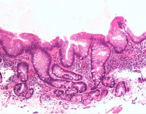 Giourdas Xeirourgiki Βασίλειος Γκιούρδας Βαρϊατρική παχυσαρχία γαστρικό μανίκι γαστρικό μπότοξ botox διαφραγματοκήλη παλινδρόμιση πτύχωση αιμορροΐδες μεταβολικό